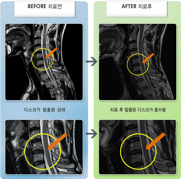 자생한방병원 치료사례 MRI로 보는 치료결과-항상 뻣뻣한 목 통증으로 목이 잘 돌아가지 않는 상태
