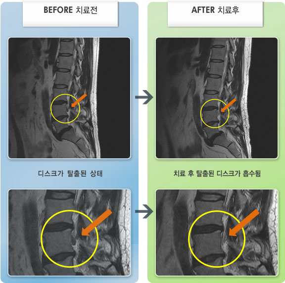 자생한방병원 치료사례 MRI로 보는 치료결과-허리 통증이 심하여 굽히거나 펴지 못하고 움직임이 제한된 상태