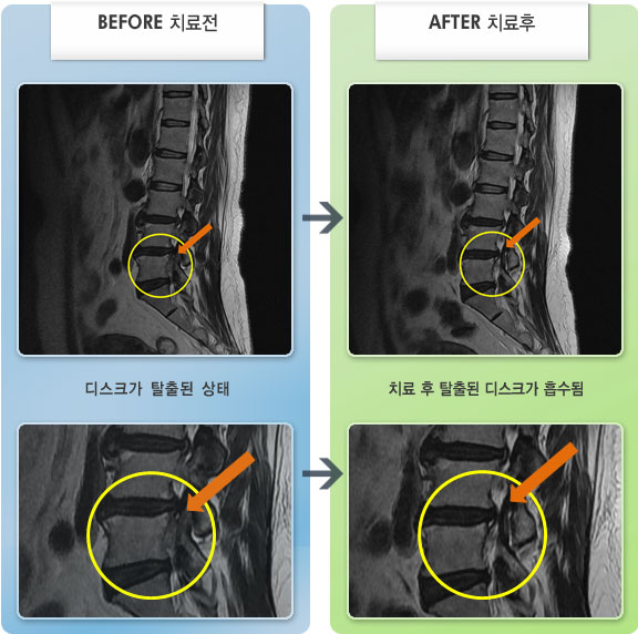 자생한방병원 치료사례 MRI로 보는 치료결과-허리 뻐근하고 우측 허벅지에서 종아리까지 저림