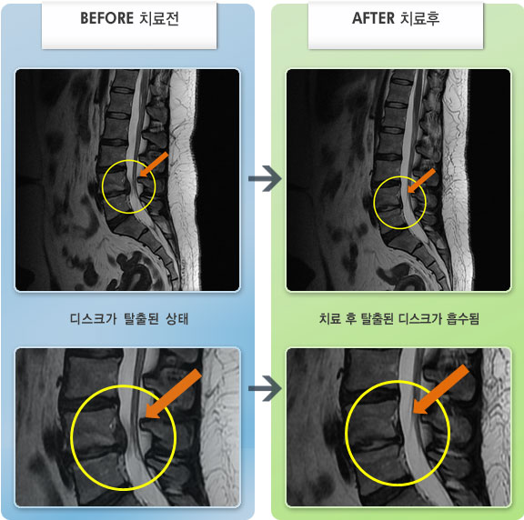 자생한방병원 치료사례 MRI로 보는 치료결과-허리 통증이 있고 앉았다 일어날때 통증이 증가되었다.
