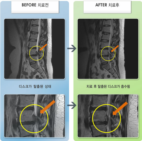 자생한방병원 치료사례 MRI로 보는 치료결과-허리 통증과 야간통이 심한 상태