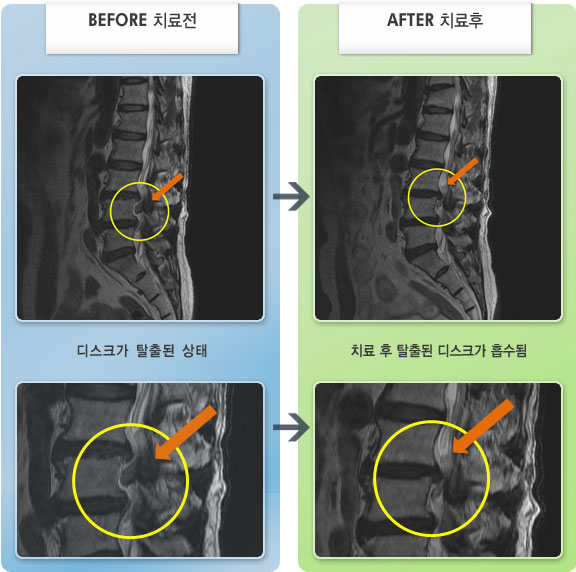 자생한방병원 치료사례 MRI로 보는 치료결과-허리 통증이 심하여 앉아 있지 못하고 허리가 굽은 상태