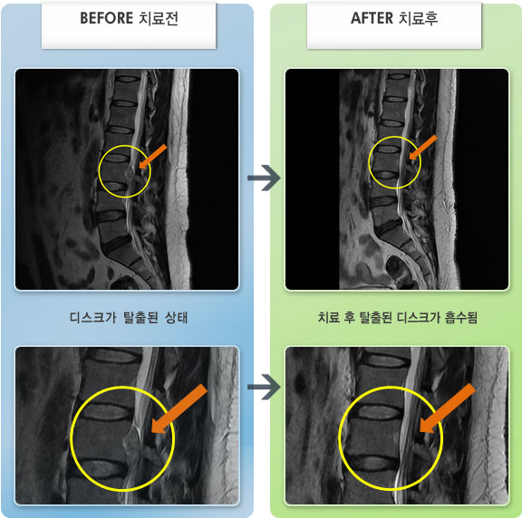 자생한방병원 치료사례 MRI로 보는 치료결과-허리와 우측 하지 방산통으로 움직임 제한이 심하였다.