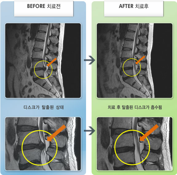자생한방병원 치료사례 MRI로 보는 치료결과-허리통증과 좌측 다리가 시큰거림으로 일상생활이 어려운 상태