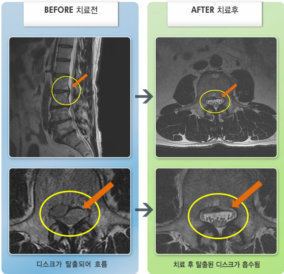 자생한방병원 치료사례 MRI로 보는 치료결과-우측 허벅지부터 발바닥까지 저린감이 심해서 일상생활이 불편한 상태