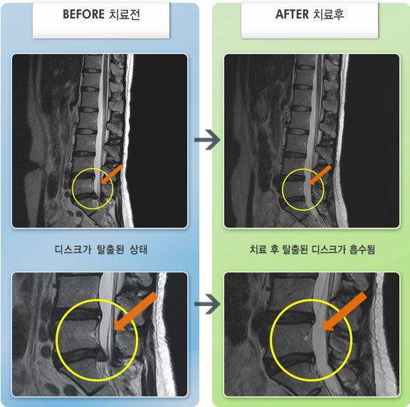 자생한방병원 치료사례 MRI로 보는 치료결과-수면이 불가능한 정도의 심한 통증