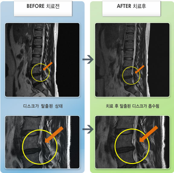자생한방병원 치료사례 MRI로 보는 치료결과-우측 다리 통증이 심하고 감각 저하 증상