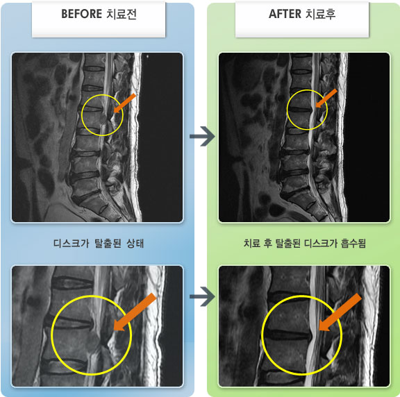 자생한방병원 치료사례 MRI로 보는 치료결과-일상생활 중 갑자기 좌측 옆구리가 아프면서 허벅지 앞쪽으로 경련 및 저림증상이 생겨 걷기 힘든 상태였다.
