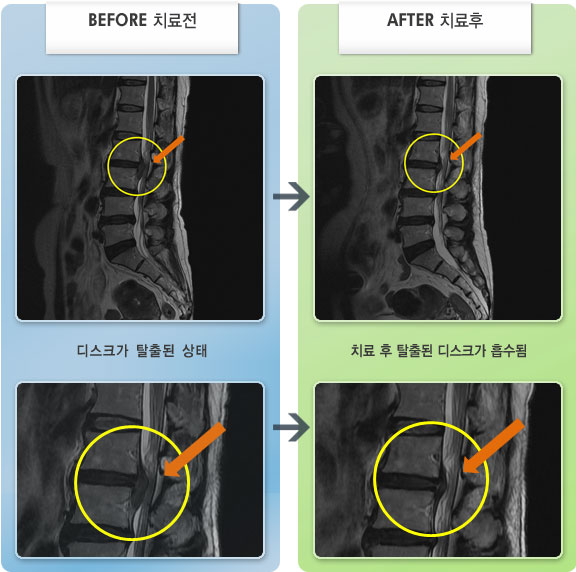 자생한방병원 치료사례 MRI로 보는 치료결과-허리 통증이 심하여 굽히거나 펴지 못하고 움직임이 자유롭지 못했다.