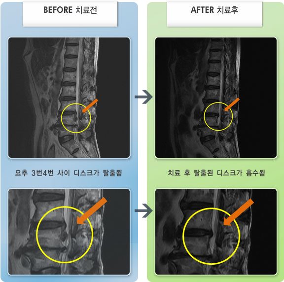 자생한방병원 치료사례 MRI로 보는 치료결과-왼쪽 다리 저림 및 통증으로 보행이 불가능한 상태였으며 마비감
