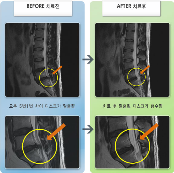 자생한방병원 치료사례 MRI로 보는 치료결과-허리부터 왼쪽 엉덩이가 당기며 운전하거나 앉을 때 통증 심하였다.