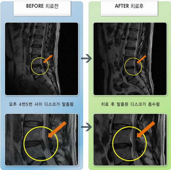 자생한방병원 치료사례 MRI로 보는 치료결과-허리 통증이 심하여 움직일수 없는 상태