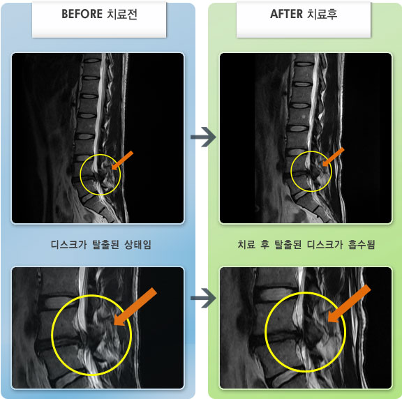 자생한방병원 치료사례 MRI로 보는 치료결과-허리와 골반통증으로 걷는 것이 불편한 상태