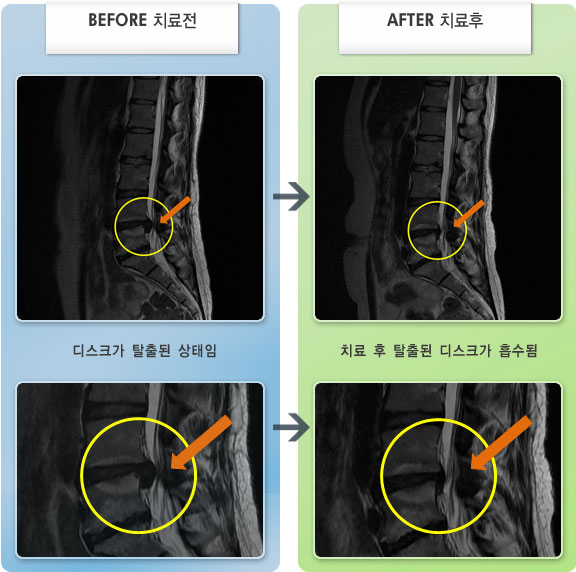 자생한방병원 치료사례 MRI로 보는 치료결과-일상생활과 수면시 어려움이 있었다.