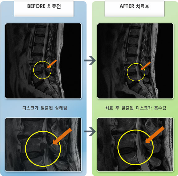 자생한방병원 치료사례 MRI로 보는 치료결과-우측 허리와 엉치 통증으로 움직임이 제한, 수면이 어려우며 우측 고관절,허벅지, 종아리 까지 감각이 둔해짐