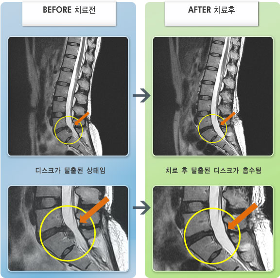 자생한방병원 치료사례 MRI로 보는 치료결과-디스크 수술 이후 허리 통증과 양쪽 다리 당기는 증상이 다시 발생