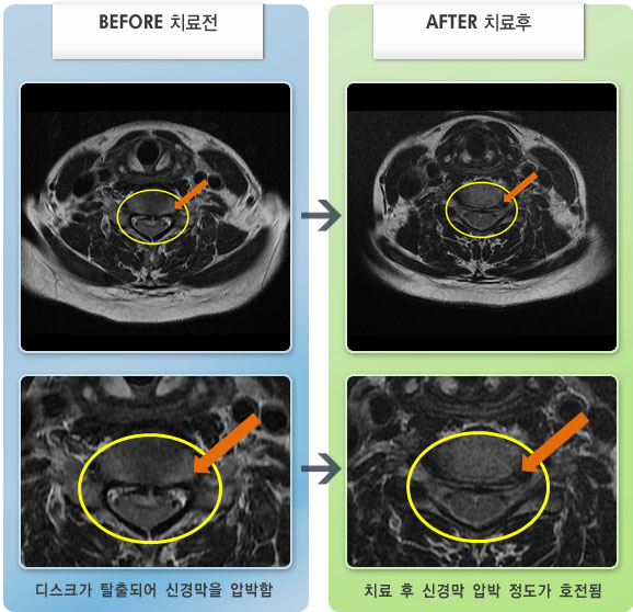 자생한방병원 치료사례 MRI로 보는 치료결과-어깨 통증 및 손끝까지 저림이 심했다.