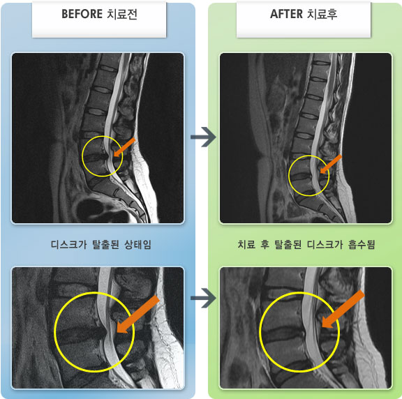 자생한방병원 치료사례 MRI로 보는 치료결과-허리 및 꼬리뼈 부위 빠지는 통증과 양쪽 다리가 저리고 당김