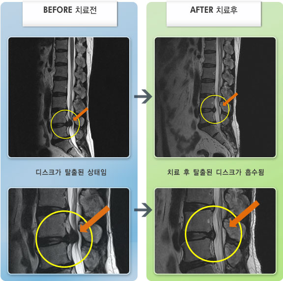 자생한방병원 치료사례 MRI로 보는 치료결과-허리디스크로 인한 허리 통증 및 방산통