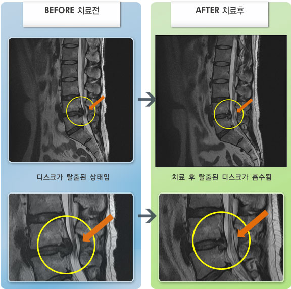 자생한방병원 치료사례 MRI로 보는 치료결과-허리 통증과 오른쪽 하지 저림이 심하였다.