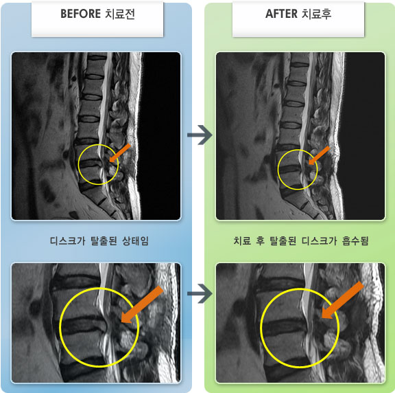 자생한방병원 치료사례 MRI로 보는 치료결과-우측 하부 요추부 통증 및 우측 둔부에서 종아리 측면으로 통증이 심했다.