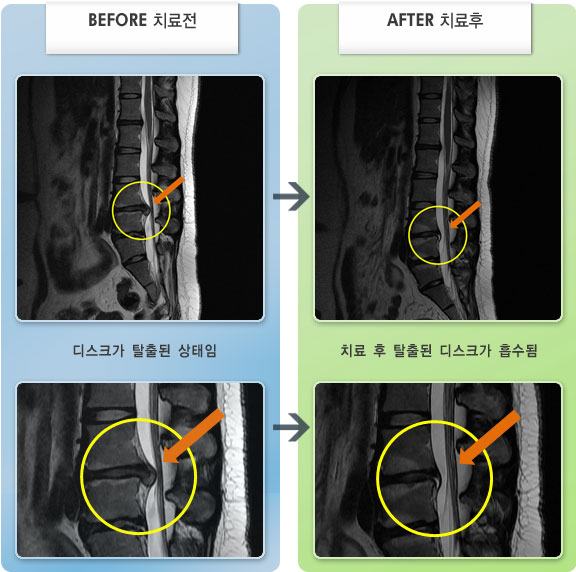 자생한방병원 치료사례 MRI로 보는 치료결과-허리디스크로 인한 허리 및 하지 저림
