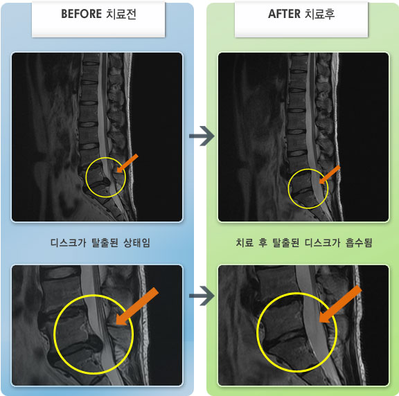 자생한방병원 치료사례 MRI로 보는 치료결과-허리디스크로 인한 허리 통증 및 다리 저림
