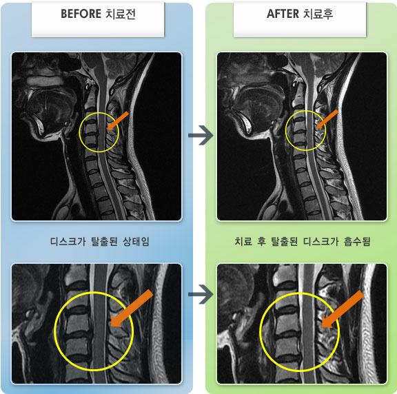 자생한방병원 치료사례 MRI로 보는 치료결과-목디스크로 인한 목통증