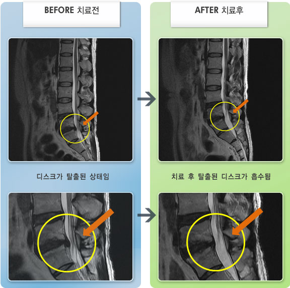 자생한방병원 치료사례 MRI로 보는 치료결과-허리디스크로 인한 왼쪽 발 저림 증세
