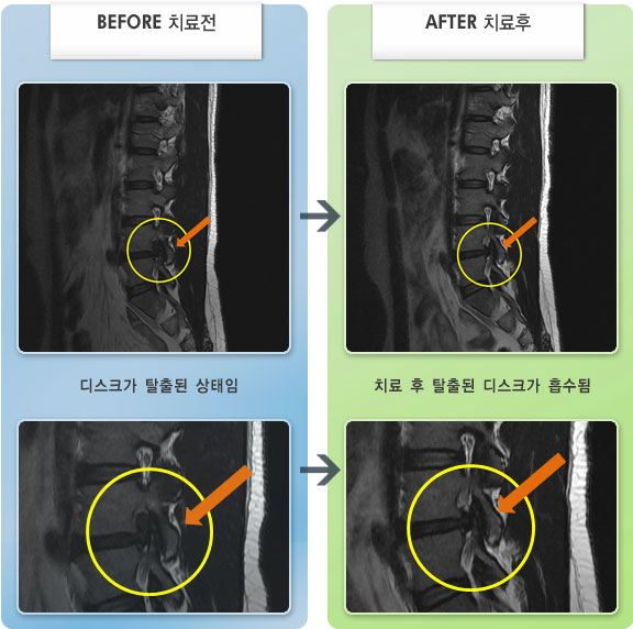 자생한방병원 치료사례 MRI로 보는 치료결과-허리 통증과 우측 고관절과 대퇴 부위로 당김이 심하였다. 