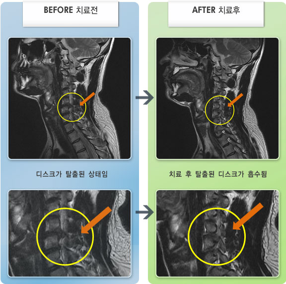 자생한방병원 치료사례 MRI로 보는 치료결과-좌측 목에서 어깨, 팔까지 저림이 있었다. 