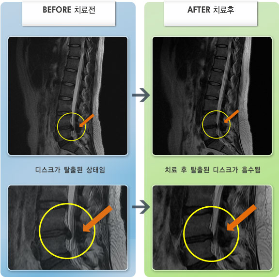 자생한방병원 치료사례 MRI로 보는 치료결과-허리디스크로 인한 요통