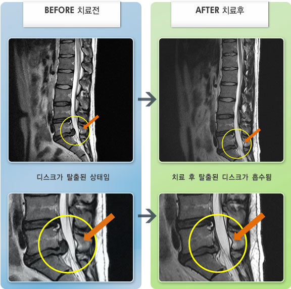자생한방병원 치료사례 MRI로 보는 치료결과-허리디스크로 인한 우측 하지 저림 증세