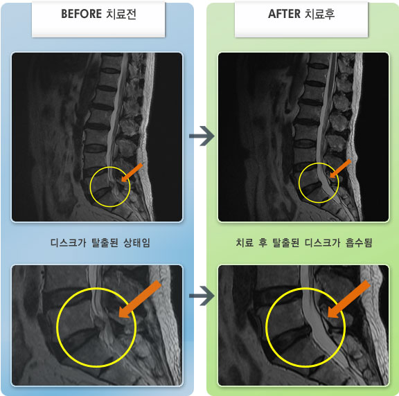 자생한방병원 치료사례 MRI로 보는 치료결과-허리디스크로 인한 왼쪽 엉치 통증