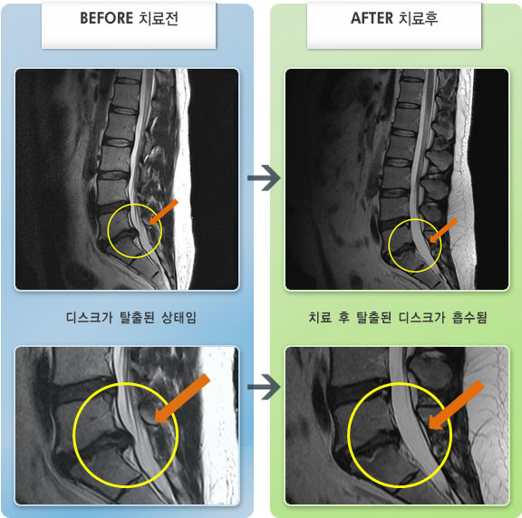 자생한방병원 치료사례 MRI로 보는 치료결과-허리디스크로 인한 엉치 및 종아리 저림 증상
