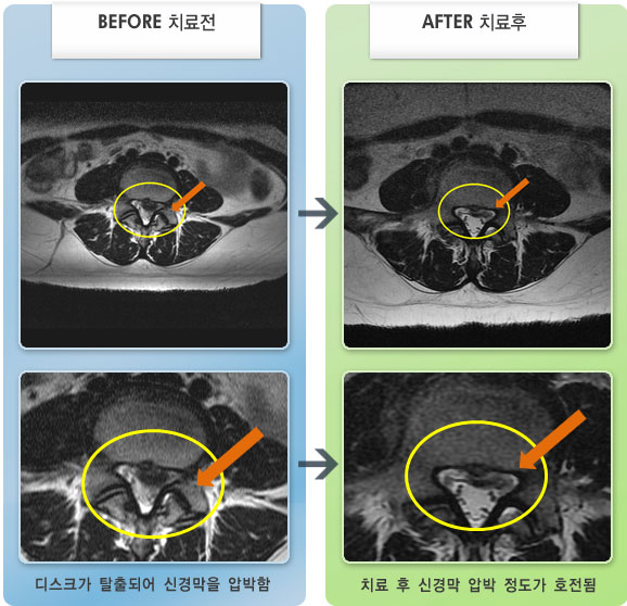 자생한방병원 치료사례 MRI로 보는 치료결과-허리디스크로 인한 왼쪽 다리 저림 증상