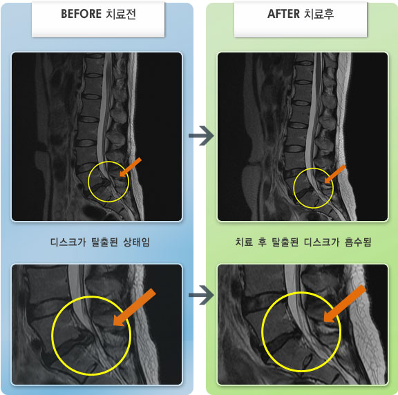 자생한방병원 치료사례 MRI로 보는 치료결과-허리디스크로 인한 왼쪽 엉덩이 통증