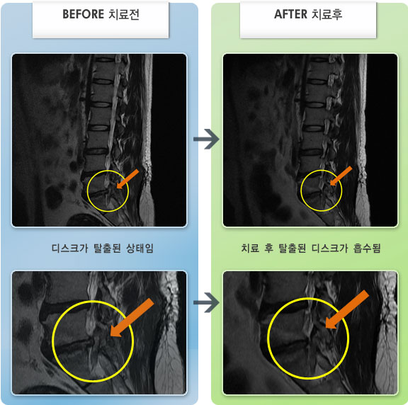 자생한방병원 치료사례 MRI로 보는 치료결과-허리가 뻐근하고 우측 다리 저림이 심하였다. 