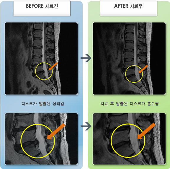 자생한방병원 치료사례 MRI로 보는 치료결과-허리디스크로 인한 하지 방사통