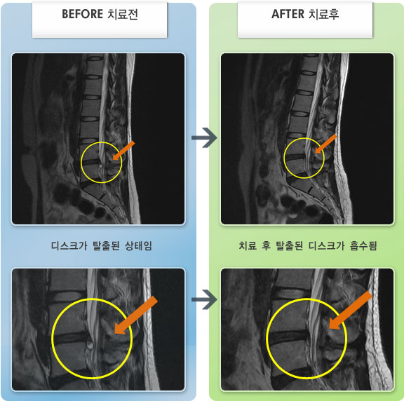 자생한방병원 치료사례 MRI로 보는 치료결과-허리디스크로 인한 허리통증