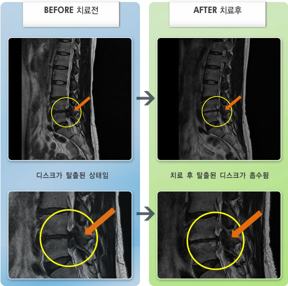 자생한방병원 치료사례 MRI로 보는 치료결과-허리디스크로 인한 우측 엉치부터 발끝 통증