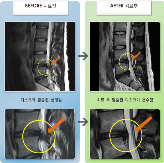 자생한방병원 치료사례 MRI로 보는 치료결과-허리디스크로 인한 허리 및 다리 통증