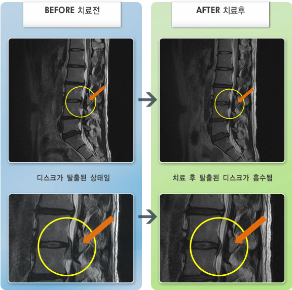 자생한방병원 치료사례 MRI로 보는 치료결과-허리디스크로 인한 왼쪽 엉치 및 허벅지 방사통