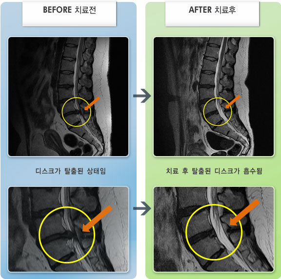 자생한방병원 치료사례 MRI로 보는 치료결과-허리디스크로 인한 허리 및 우측 허벅지 통증