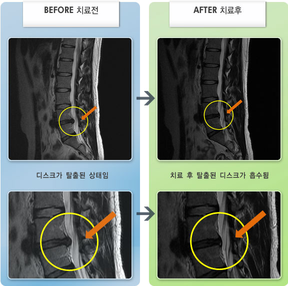 자생한방병원 치료사례 MRI로 보는 치료결과-허리디스크로 인한 양측 둔부 및 대퇴, 소퇴부 저림 증상