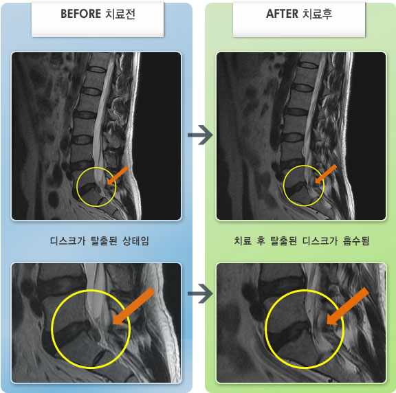 자생한방병원 치료사례 MRI로 보는 치료결과-허리디스크로 인한 좌측 둔부 통증 및 배뇨장애