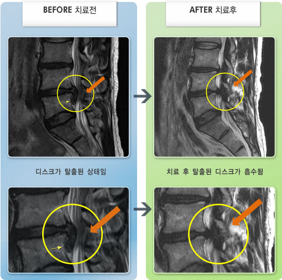 자생한방병원 치료사례 MRI로 보는 치료결과-좌측 하지 감각이상과 저림증상이 극심하여 거동이 힘든 상태였다.