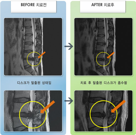 자생한방병원 치료사례 MRI로 보는 치료결과-허리디스크로 인한 허리 통증 및 다리저림