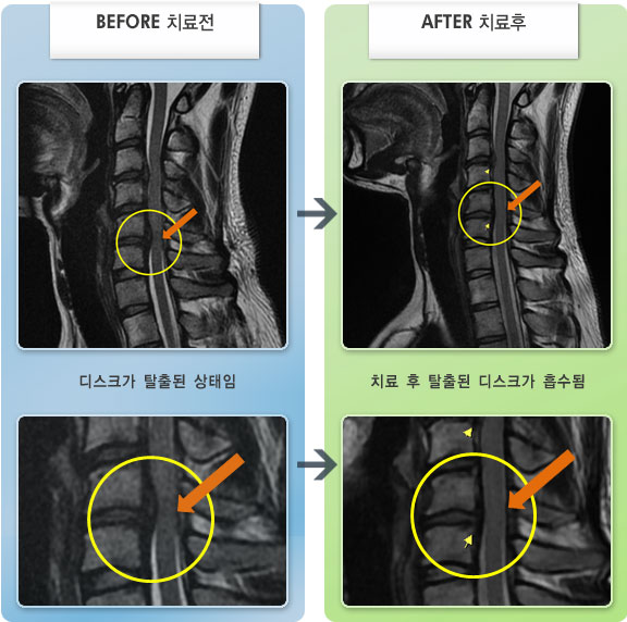 자생한방병원 치료사례 MRI로 보는 치료결과-목디스크로 인한 목 통증 및 좌측 상지 무력감