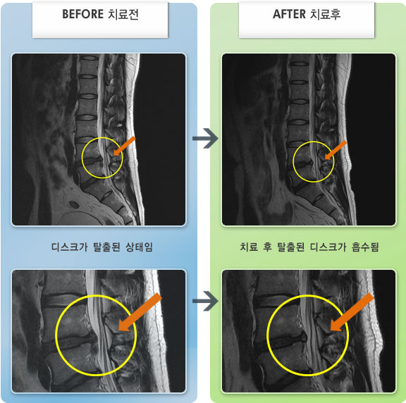 자생한방병원 치료사례 MRI로 보는 치료결과-요통 및 좌측 엉치 통증이 심하고 대퇴부, 종아리, 발바닥까지 저림이 심하여 자가보행이 불가능한 상태였다.